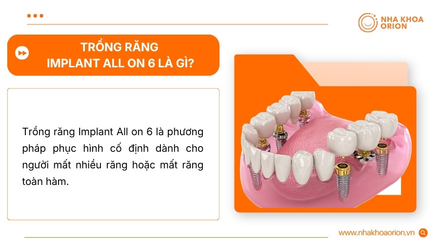 Implant All on 6 sử dụng 6 trụ Implant để n&acirc;ng đỡ h&agrave;m răng cố định tr&ecirc;n một cung h&agrave;m
