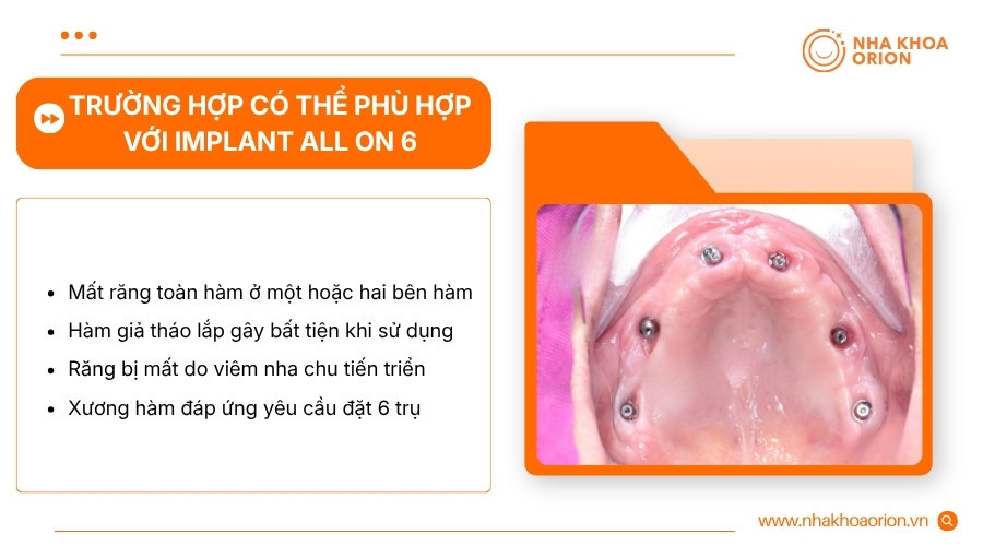 Người mất nhiều răng c&oacute; thể được chỉ định All on 6 khi đ&aacute;p ứng c&aacute;c điều kiện cần thiết