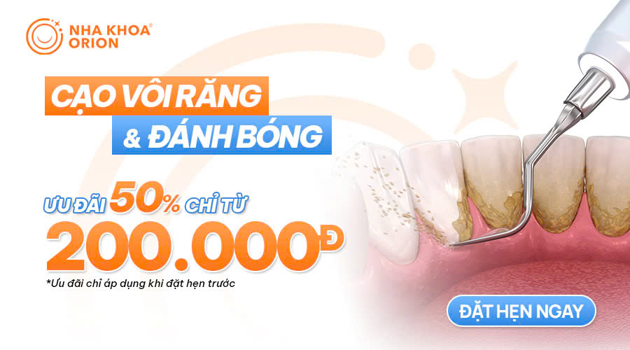 Cạo v&ocirc;i răng giảm 50%